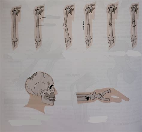 Fractures Diagram | Quizlet