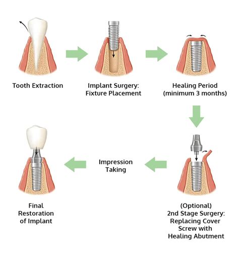 What Are Dental Implants and Am I Suitable for Them? - Medisave-Claimable