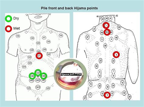 7 best images about Hijama on Pinterest | What is, Diabetes and Asthma