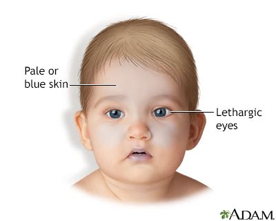 Shaken baby syndrome Information | Mount Sinai - New York