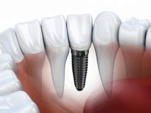 Dental Implant Infection: Signs and Remedies | UtoDent.com