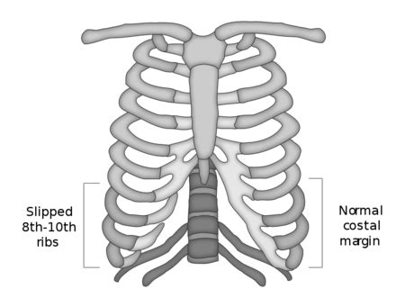 False Broken Ribs