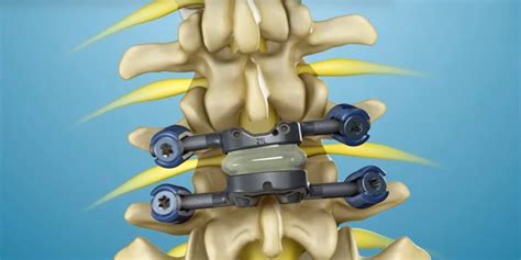 New Study Examines Facet Replacement for Spondy, Stenosis | Orthopedics This Week