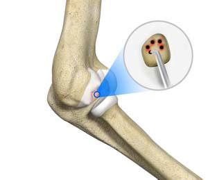 Cartilage Replacement - Florida Ortho Care