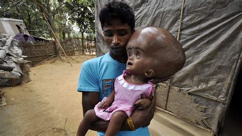 Help For Girl With Rare Giant Head Syndrome | World News | Sky News