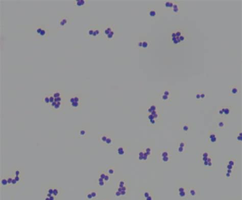 Cureus | Aerococcus urinae Infective Endocarditis