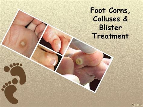 Foot corns, calluses & blister treatment