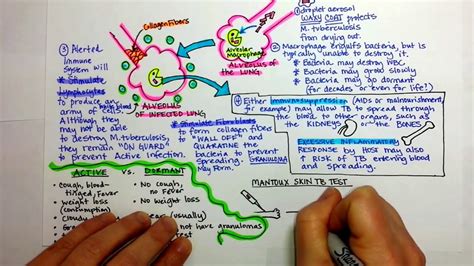 Tuberculosis Pathogenesis - YouTube