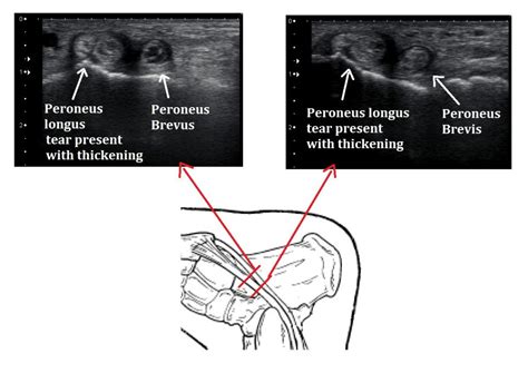 Peroneal Tendinopathy - Ankle, Foot and Orthotic Centre