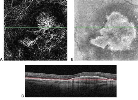 OCT angiography of CNV - American Academy of Ophthalmology