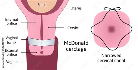 Transabdominal cerclage tightening of cervix opening during pregnancy. Anatomy of cervix ...