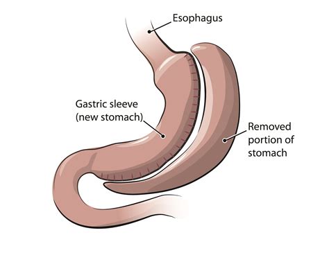 Louisiana Surgeons of Excellence - Sleeve Gastrectomy