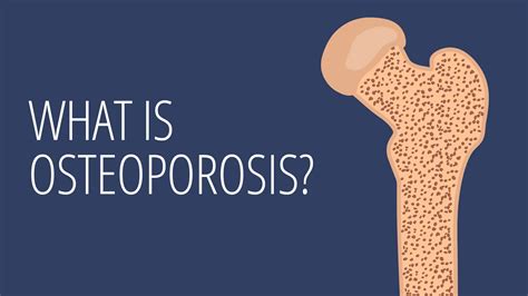 Osteoporosis, Explained in Under 2 Minutes - GoodRx