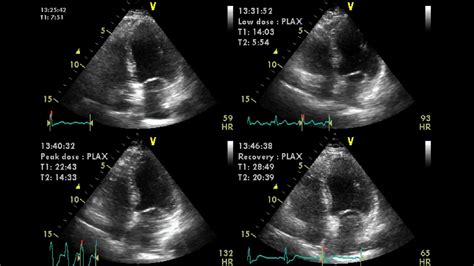 Dobutamine Stress Echo - YouTube