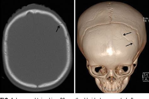 Skull fracture - pastorestate