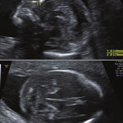 Nuchal fold (NF) values in euploid fetuses. | Download Scientific Diagram