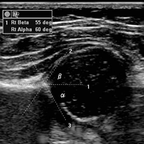 Normal infant hip ultrasound | Radiology Case | Radiopaedia.org ...