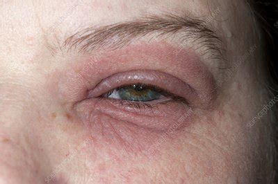 Eczema around the eye - Stock Image - C011/1670 - Science Photo Library