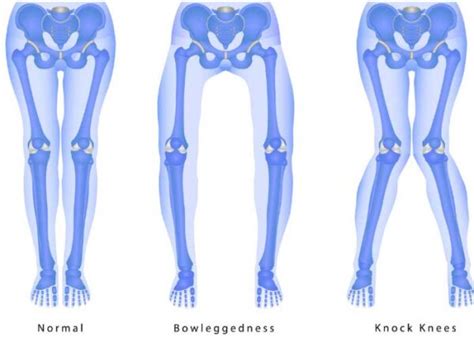 Knee Malalignment | Varus | Valgus| Sugar Land, Pearland, Houston, TX