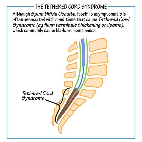 definition of tethered cord