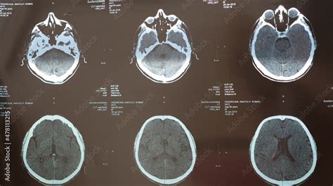 MRI of the braiMRI scan of the human brain after traumatic brain ...