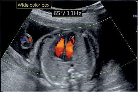 Color Doppler in Fetal Echocardiography | Obgyn Key