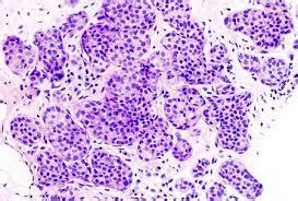 Invasive Lobular Carcinoma