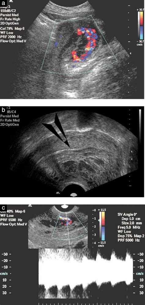 Organized Hematoma Ultrasound