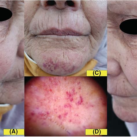 (A,B,C): Punctate lesions on an erythematous background, located on the... | Download Scientific ...