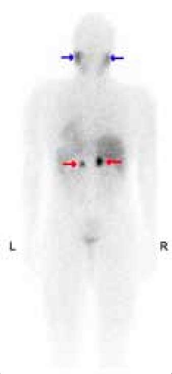 MIBg scan shows the increased uptake in both adrenal glands consistent... | Download Scientific ...