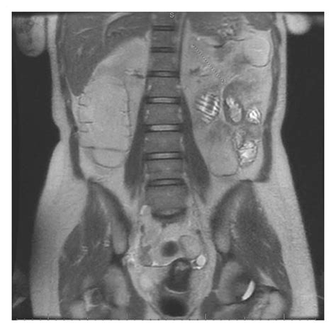 MR enterography showing small bowel obstruction with a transition point ...