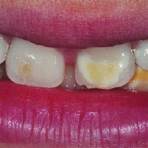 (PDF) Hypoplastic Enamel Treatment in Permanent Anterior Teeth of a Child