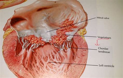 Advanced lesion on mitral valve with rupture of chordae tendinae. Also ...