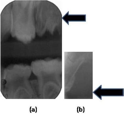 Regional Odontodysplasia - An Unusual Development