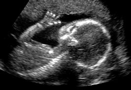 20-Week Ultrasound Images and Scans - FamilyEducation