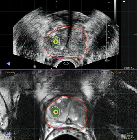 MRI-TRUS Fusion | RadNet Prostate Program