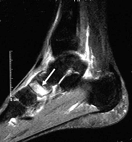 Tarsal Navicular Fractures - Foot & Ankle - Orthobullets