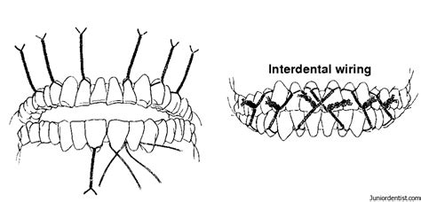 Types Of Dental Splints | Fixed and Removable Dental Splints