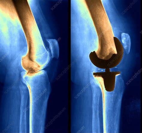 Knee replacement, X-ray - Stock Image - C053/0308 - Science Photo Library