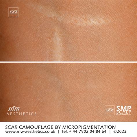 Scar Camouflage | Scar Micropigmentation | MW Aesthetics