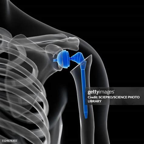 Shoulder Joint Replacement Photos and Premium High Res Pictures - Getty Images