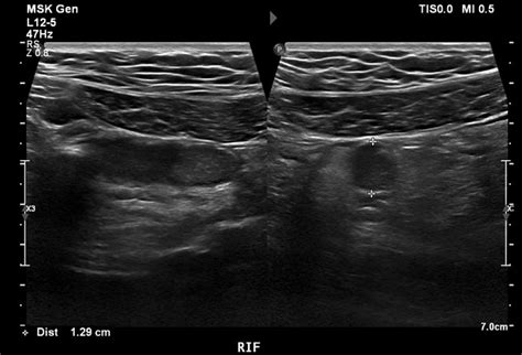 Appendicitis Ultrasound Criteria