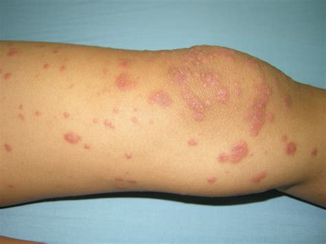 VIRTUAL GRAND ROUNDS IN DERMATOLOGY 2.0: Erythema multiforme major