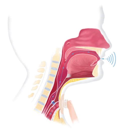 Laryngectomy HME And Other Humidification Options | Tracheostomy Education