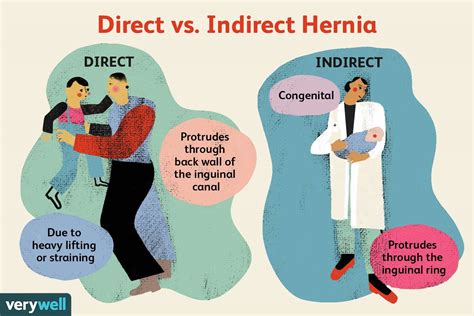 Direct vs. Indirect Hernia: Key Differences and Causes