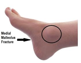 Ankle undisplaced medial malleolus fracture · Virtual Fracture Clinic