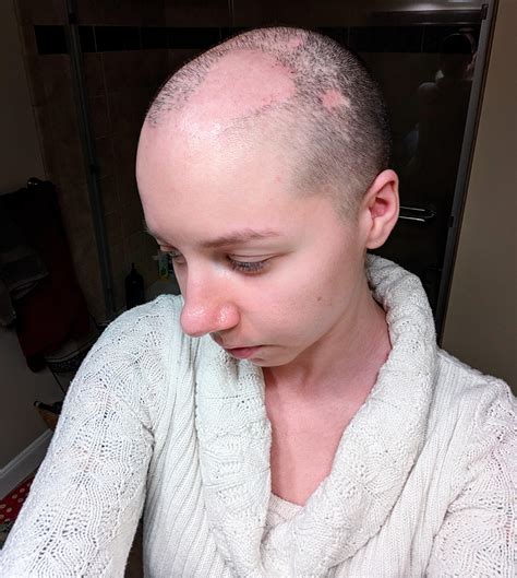 I have a rare form of Alopecia called Cicatricial Alopecia (aka Scarring Alopecia). This is what ...