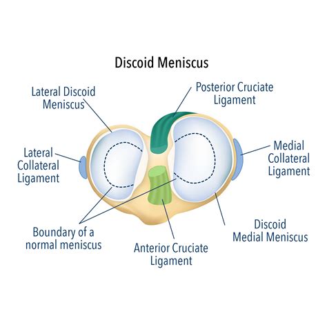 Discoid Meniscus Surgery | Discoid Meniscus Treatment