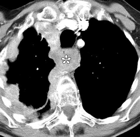 Malignant Pleural Mesothelioma: Evaluation with CT, MR Imaging, and PET ...