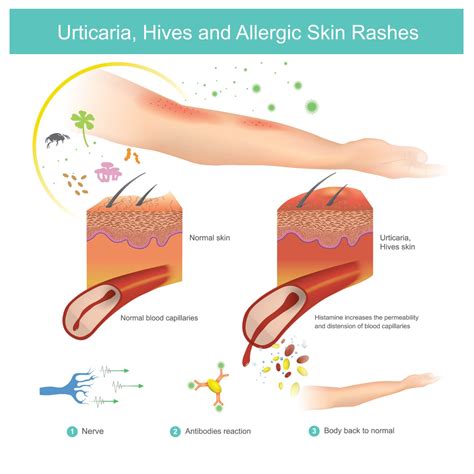 10 Frequently Asked Questions About Acute Urticaria - Facty Health